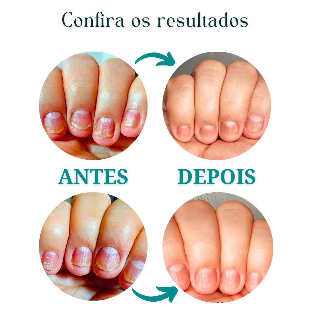 KIT FUNGIFEET (30) UNIDADES