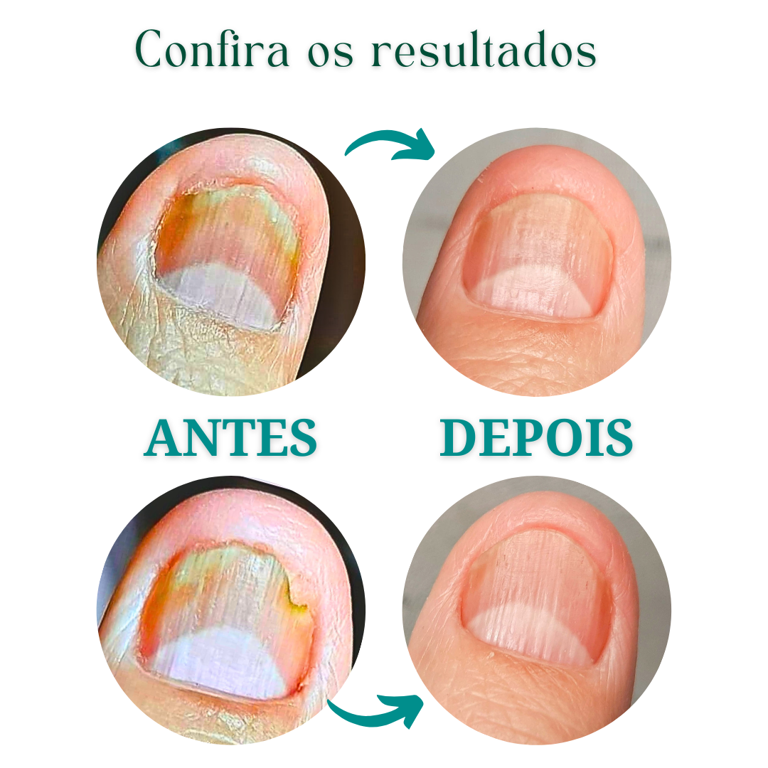 KIT FUNGIFEET (30) UNIDADES
