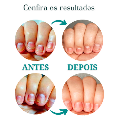 KIT FUNGIFEET (30) UNIDADES
