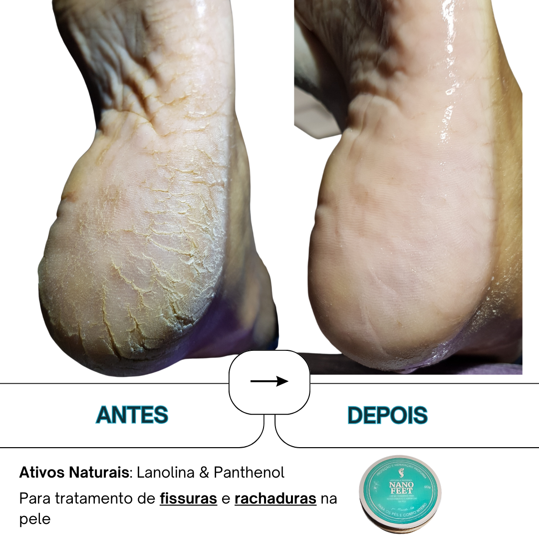 NANOFEET CREME PARA RACHADURAS E RESSECAMENTOS