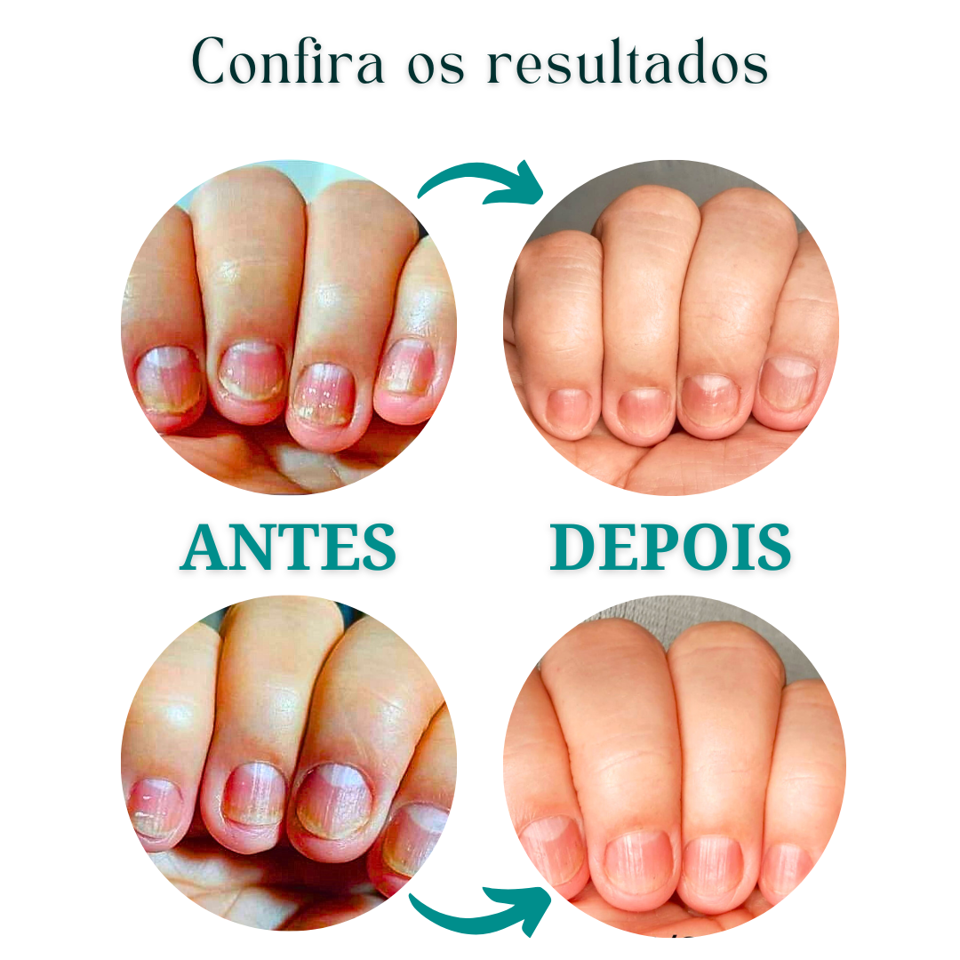 KIT DE HIDRATAÇÃO PARA OS PÉS E MÃOS (FUNGIFEET) (PODO CLEAN) (NUTRIGEL)